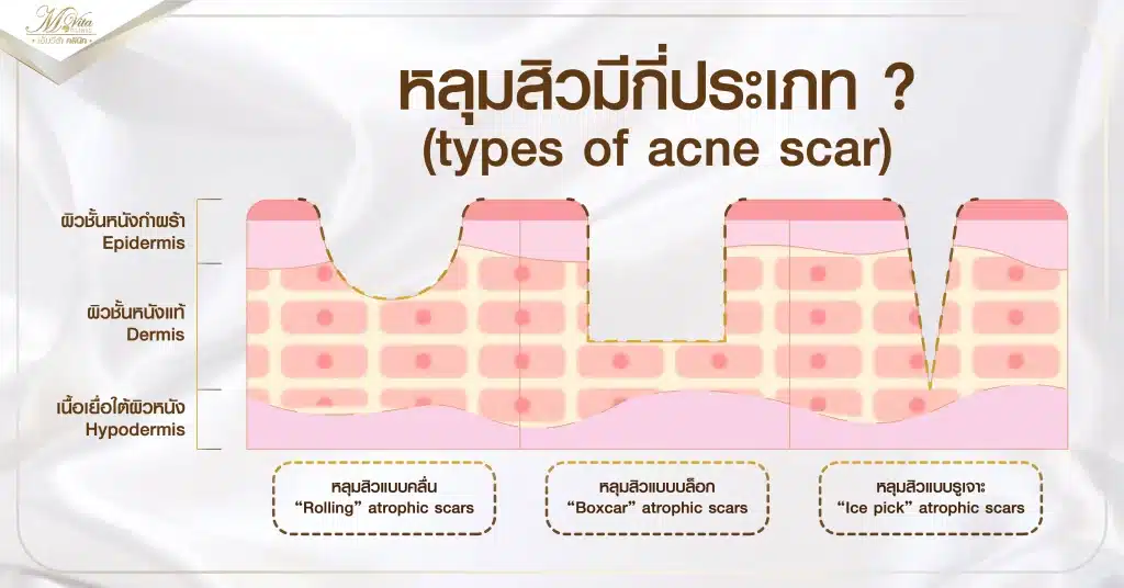 ประเภท หลุมสิว