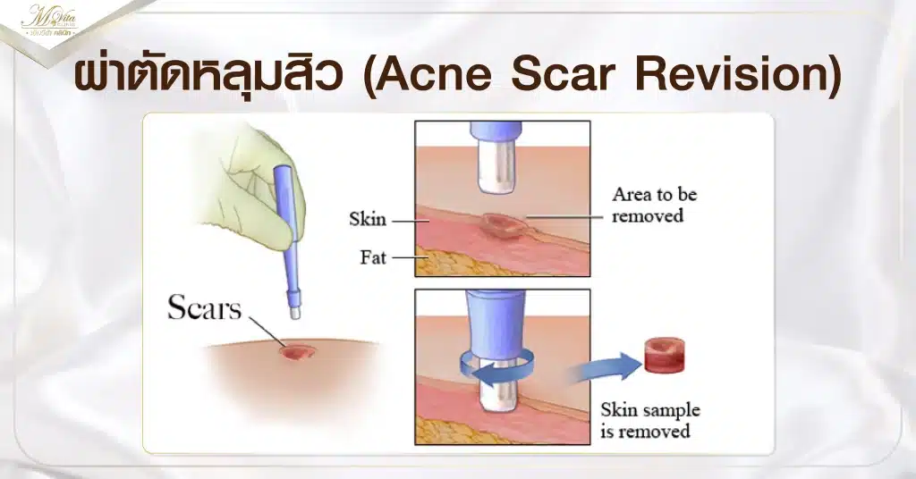 ผ่าตัดหลุมสิว (Acne Scar Revision)