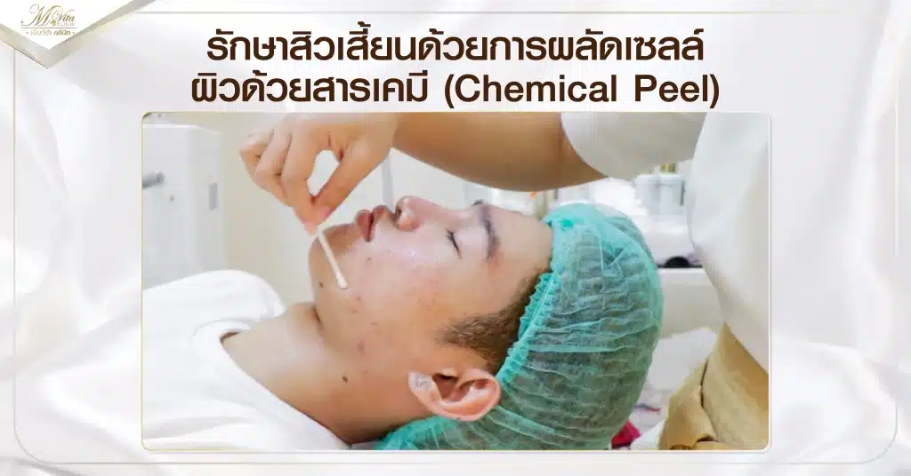 รักษาสิวเสี้ยนด้วยการผลัดเซลล์ผิวด้วยสารเคมี (Chemical Peel)