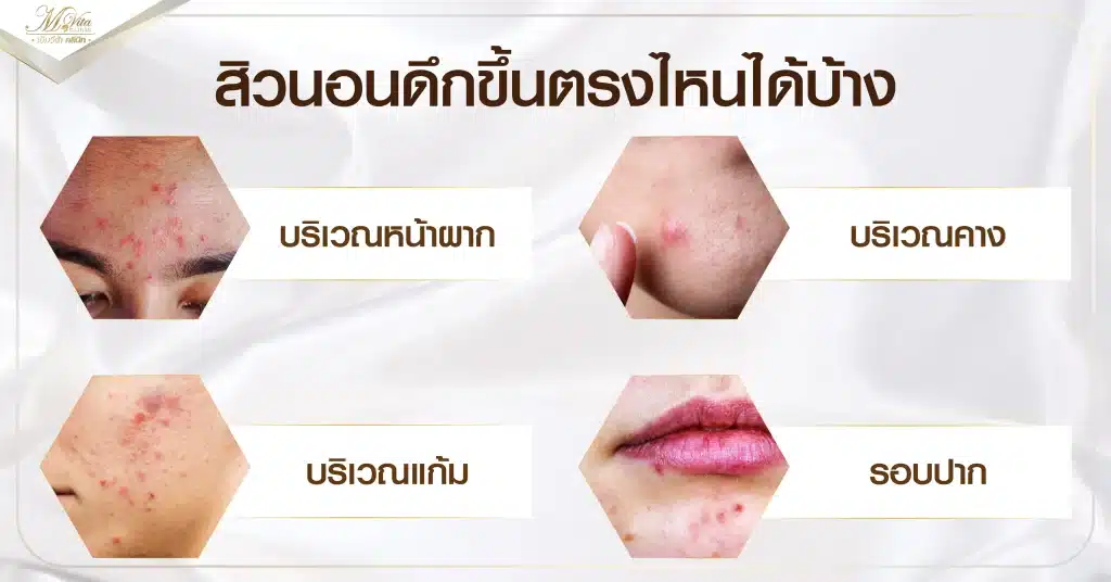 สิวนอนดึกขึ้นตรงไหนได้บ้าง