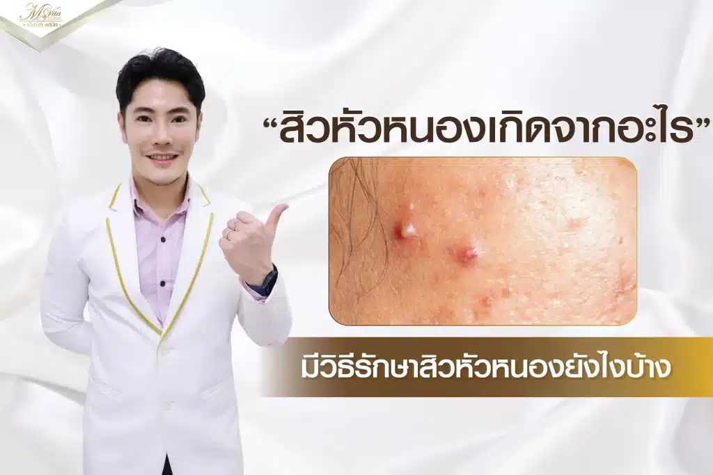 สิวหัวหนองเกิดจากอะไร