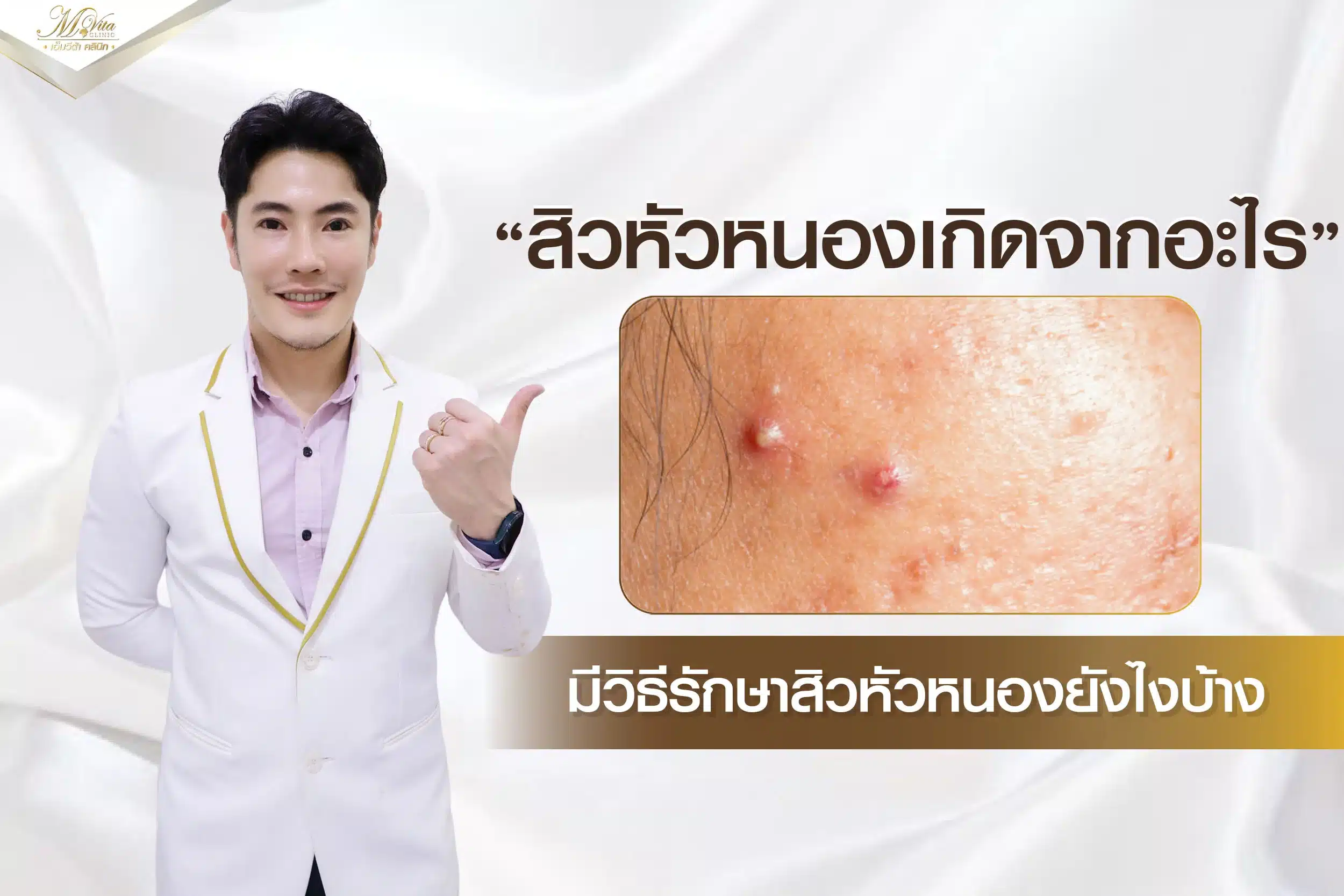 สิวหัวหนองเกิดจากอะไร มีวิธีรักษาสิวหัวหนองยังไงบ้าง