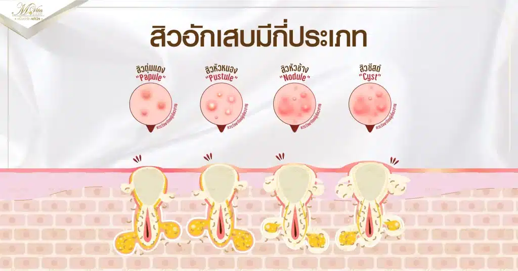 สิวอักเสบ มีกี่ประเภท