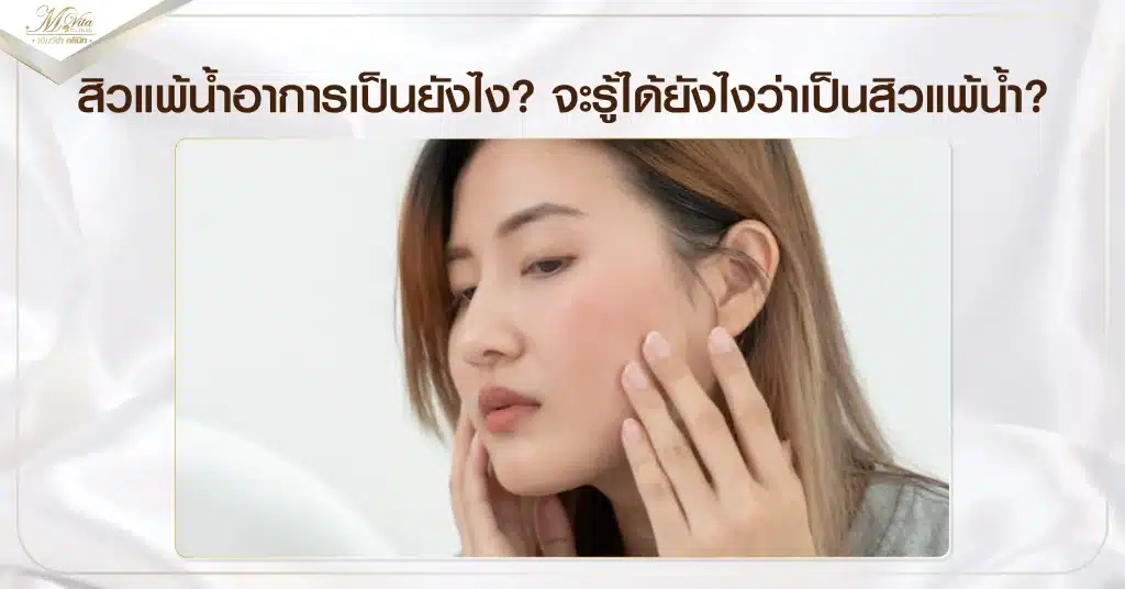 สิวแพ้น้ำอาการเป็นยังไง