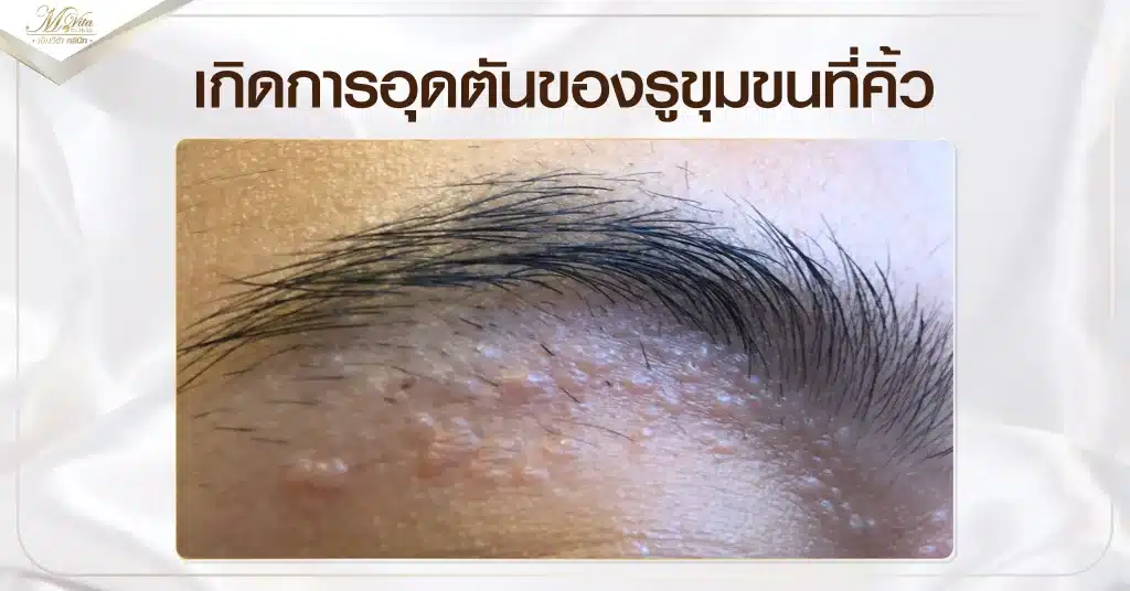 เกิดการอุดตันของรูขุมขนที่คิ้ว-01