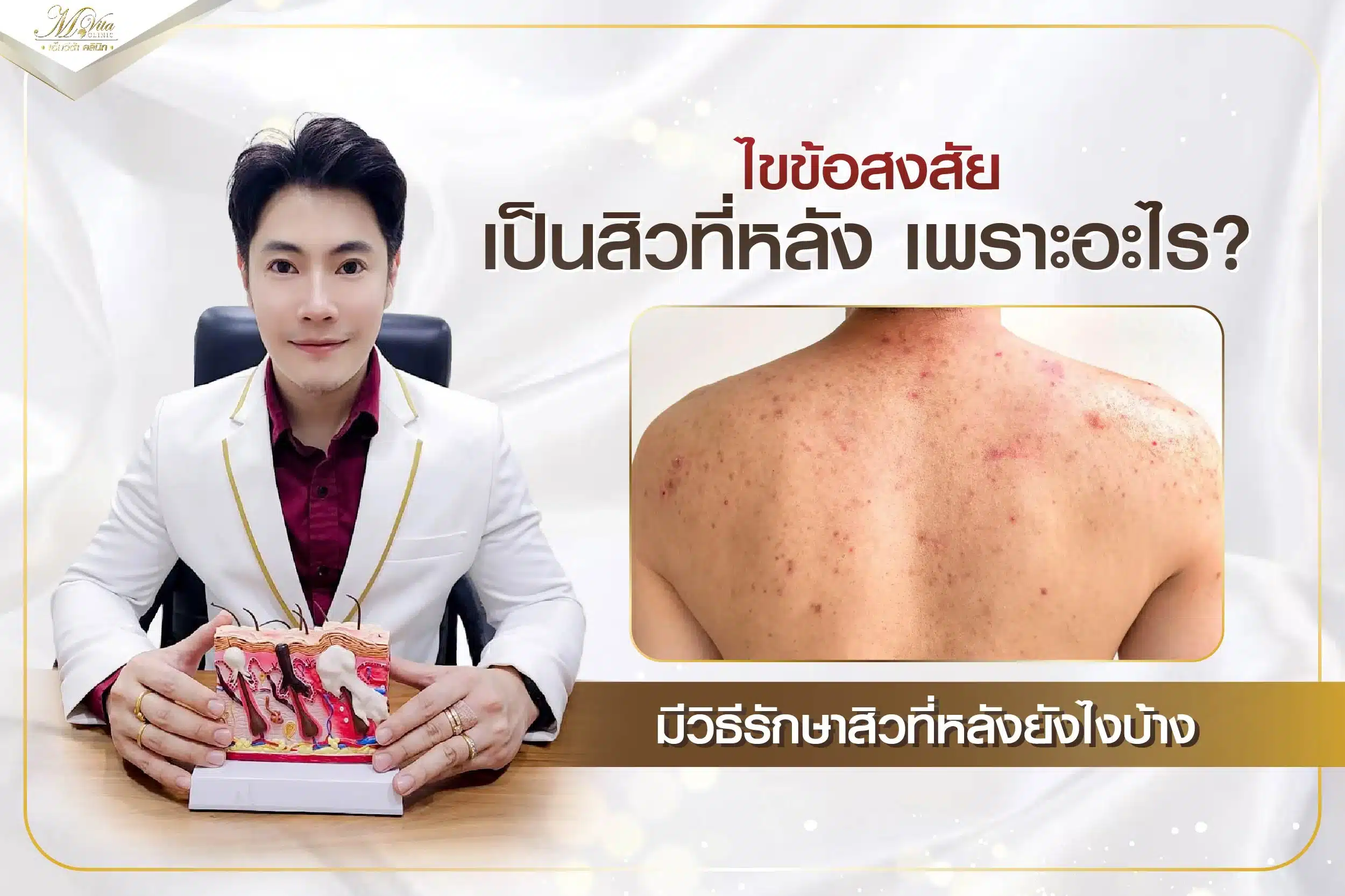 ไขข้อสงสัย เป็นสิวที่หลังเพราะอะไร? มีวิธีรักษาสิวที่หลังยังไงบ้าง