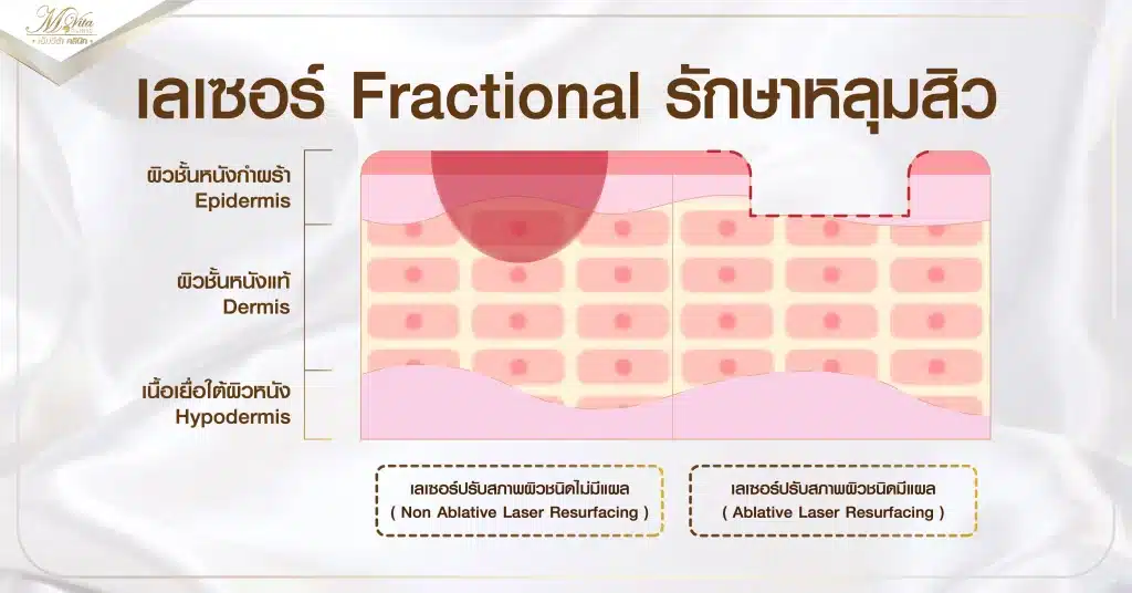 เลเซอร์ Fractional ที่รักษาหลุมสิว