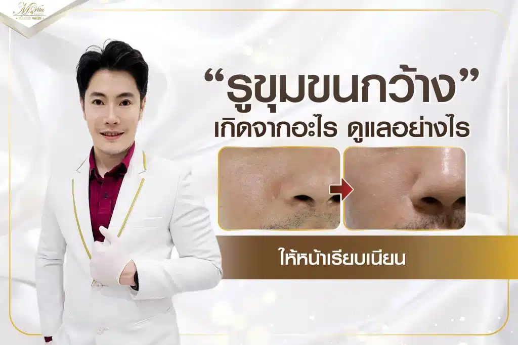 รูขุมขนกว้าง