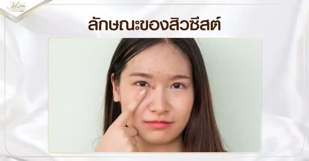 ลักษณะของสิวซีสต์