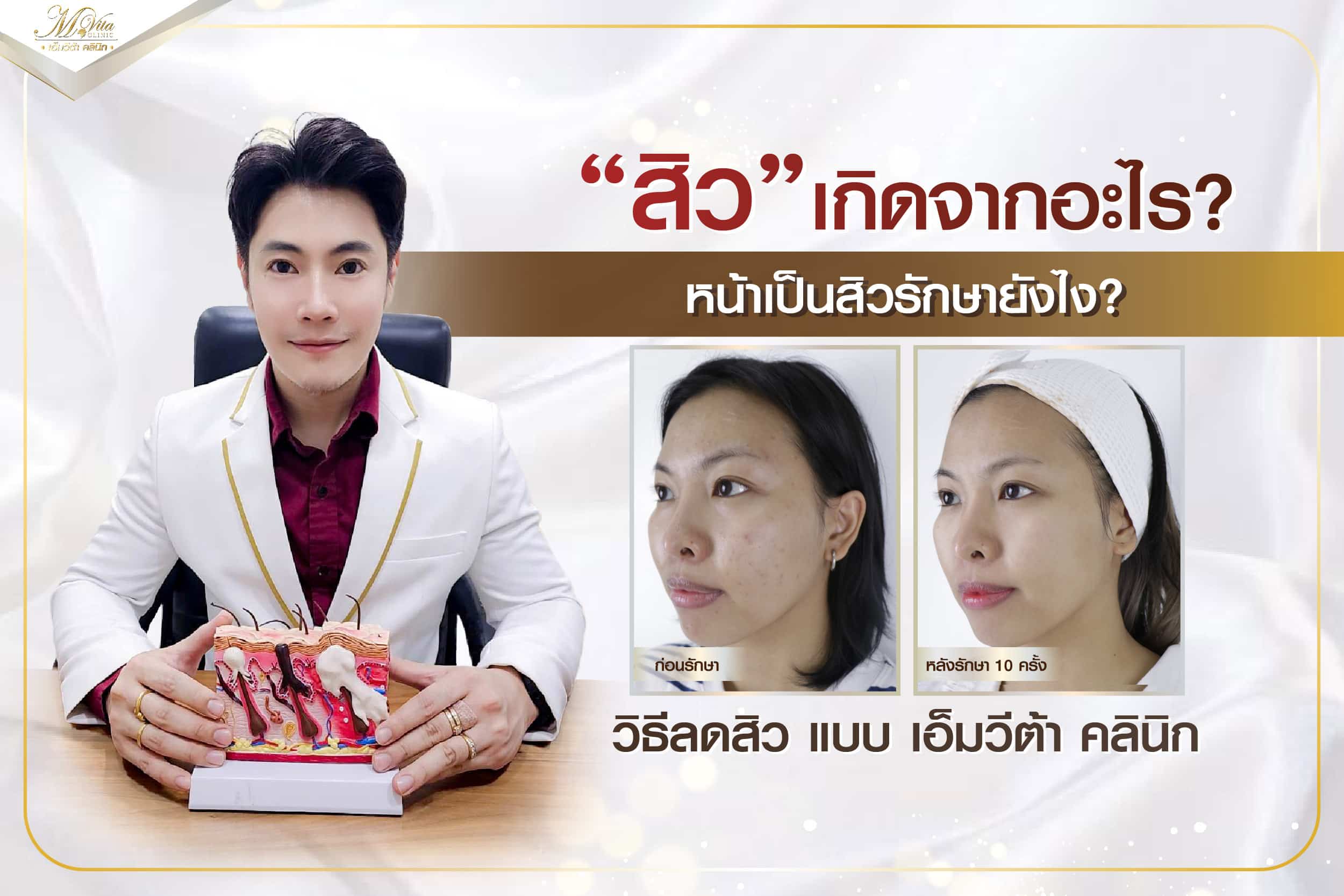 ” สิว ” เกิดจากอะไร? หน้าเป็นสิวรักษายังไง? วิธีลดสิว แบบ เอ็มวีต้า คลินิก