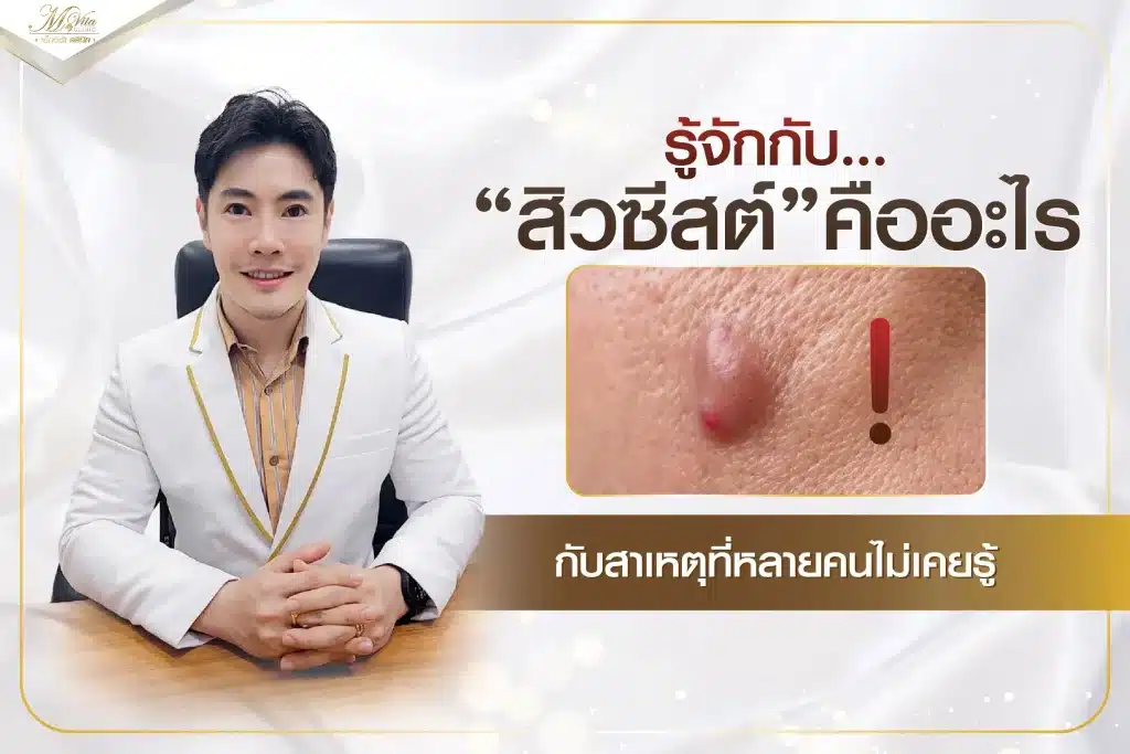 สิวซีสต์