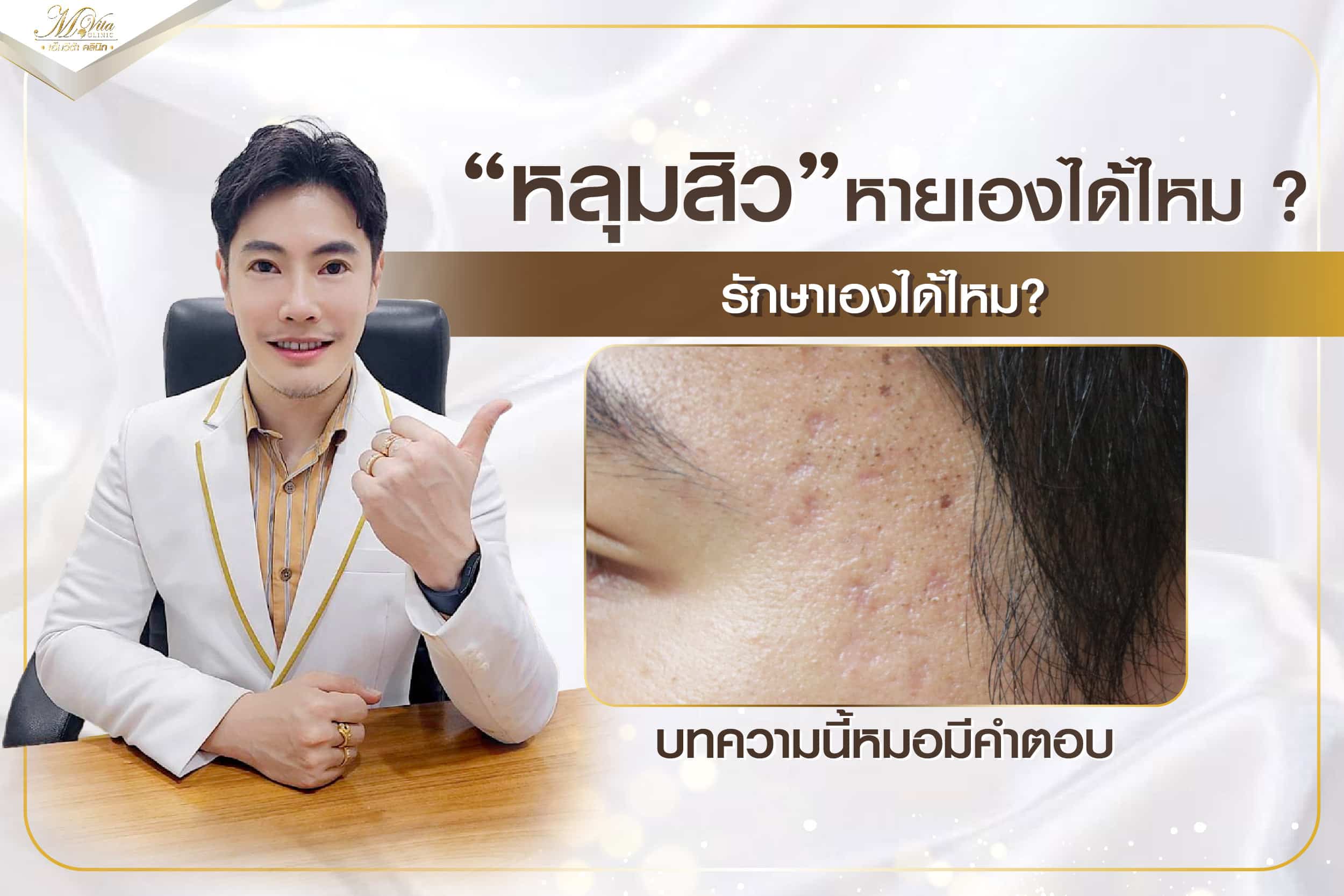 หลุมสิวหายเองได้ไหม? รักษาเองได้ไหม? บทความนี้หมอมีคำตอบ