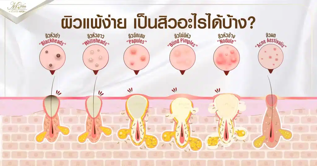 ผิวแพ้ง่าย เป็นสิวอะไรได้บ้าง_