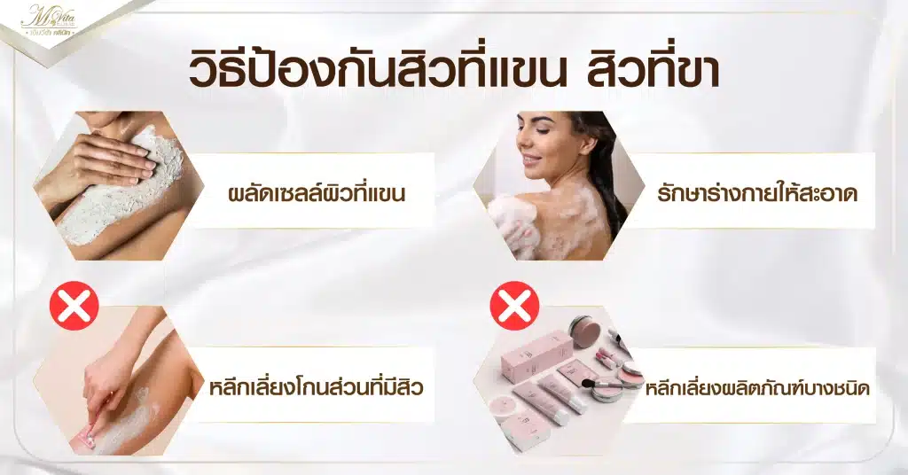 วิธีป้องกันสิวที่แขน สิวที่ขา