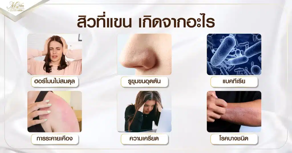 สิวที่แขน เกิดจากอะไร