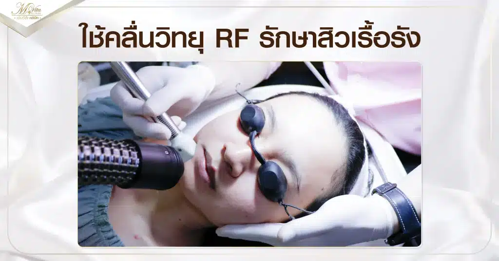 ใช้คลื่นวิทยุ RF รักษาสิวเรื้อรัง